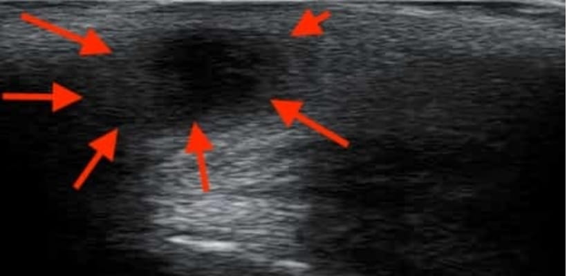 kyste pilonidal échographie